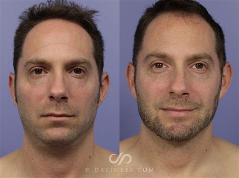 Cheek And Chin Implant In Los Angeles