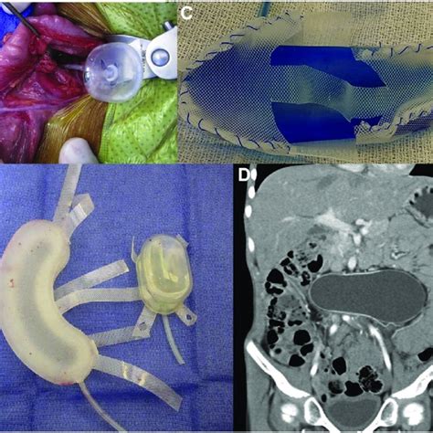 Intraoperative View Of Tissue Expander Te Stimulated Lengthening Of Download Scientific