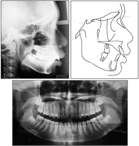 Figure From Treatment Of A Severe Class Ii Division Malocclusion