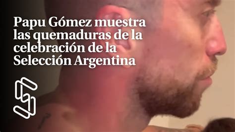 Papu Gómez muestra las quemaduras de la celebración de la Selección