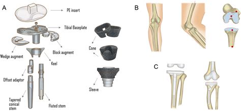 Prostheses Option In Revision Total Knee Arthroplasty From The Bench To The Bedside 1 Basic