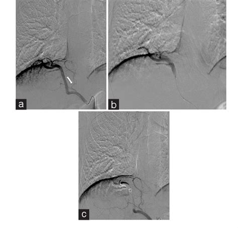 Figure 2 From Particle And Coil Arterial Embolization Of Intralobar