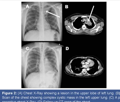 Figure 2 From Pulmonary Congenital Cystic Adenomatoid Malformation A Rare Congenital