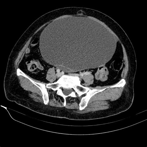 Serous Cystadenocarcinoma Ultrasound