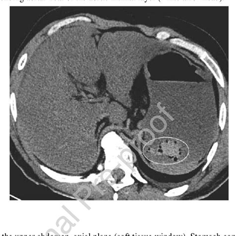 Figure 2 From Postmortem Radiological Imaging Of Natural Causes Of