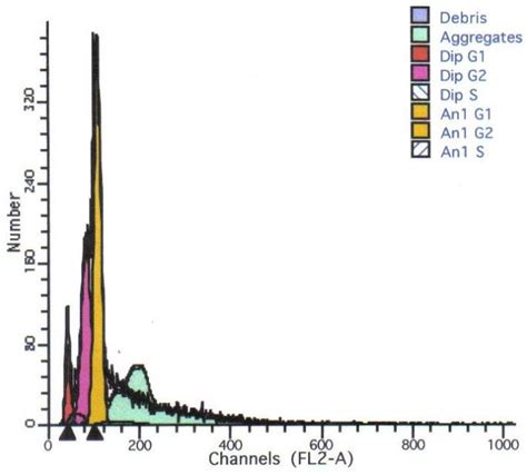 Figure 2 From DNA PLOIDY ANALYSIS OF ORAL SQUAMOUS CELL CARCINOMA A