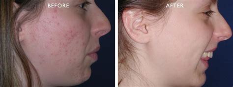 Smoothbeam Laser Patient Before And After Gallery Advanced Skin Care Laser And Body Contouring