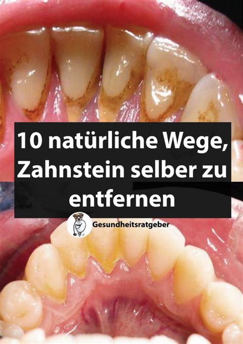 Nat Rliche Wege Zahnstein Selber Zu Entfernen Zahnstein Z Hne