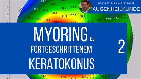 MyoRing Behandlung Von Sehr Fortgeschrittenen Keratokonus Erkrankungen