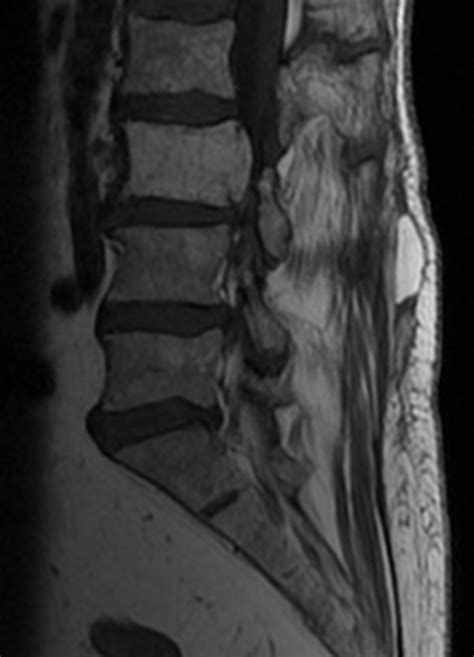 Mri Scan Revealing The Hemangioma That Expands Posteriorly To The