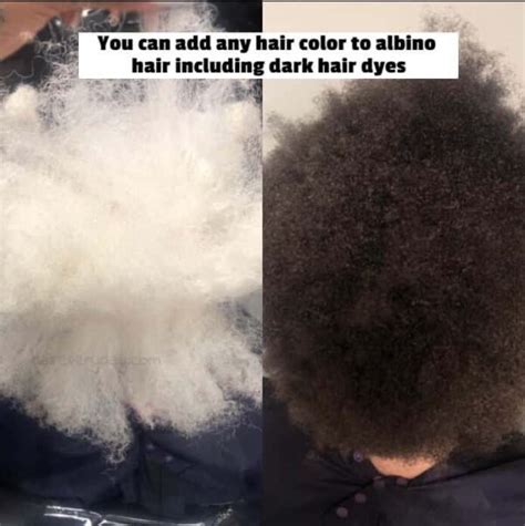 Can Albino People Dye Their Hair Interesting Facts Hair Everyday