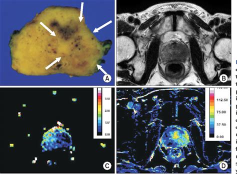 Figure 1 From Multiparametric Magnetic Resonance Imaging For Prostate