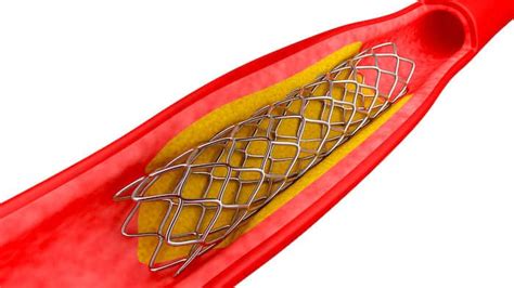 Qu Es Un Stent Todo Lo Que Necesitas Saber Tu Blog De Salud