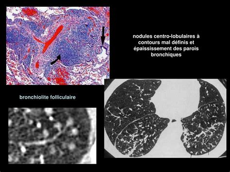 Ppt Le Syst Me Lymphatique Du Parenchyme Pulmonaire Et Sa Pathologie