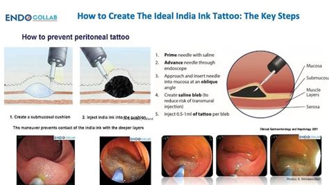 Master the Art of Endoscopy Tattoos