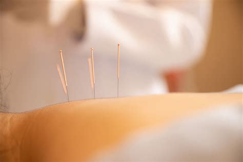 The Benefits Of Acupuncture For Sciatica Treatment