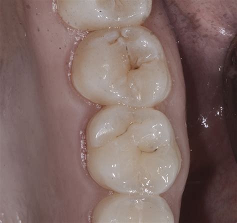 Early Detection and Treatment of Caries | October 2019 | Inside Dentistry