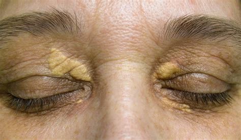 Understanding Xanthelasma - Aesthetics