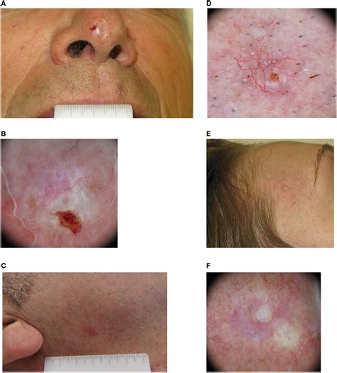 Superficial Basal Cell Carcinoma Early Stages