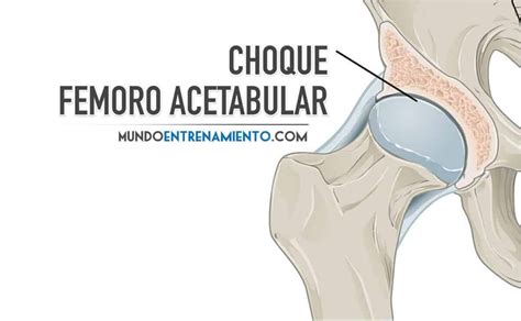 Choque Femoroacetabular Diagn Stico Y Posibles Tratamientos