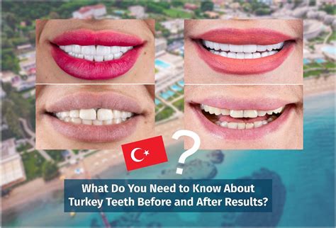 Turkey Teeth Before And After Veneers Before And After