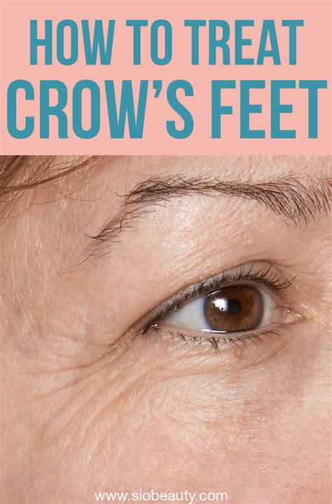 Crow’s Feet: What Causes Them And How To Treat Them