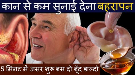 कान से कम सुनाई देने के कारण और उसका इलाज How To Cure Hearing Loss