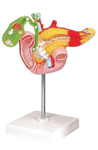 Pathological Model Of The Pancreas Duodenum And Gallbladder King