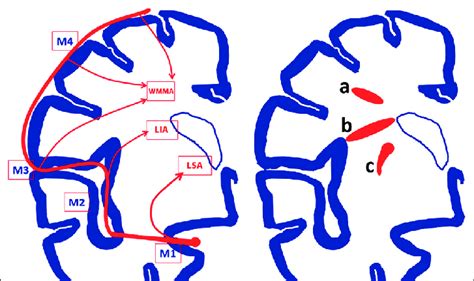 Vascular Territories Of Perforating Arteries And Their Infarct