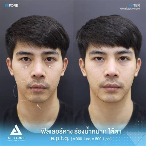 รีวิว Attitude Clinic ลำปาง รีวิวฉีดฟิลเลอร์เกาหลี Eptq ตัวใหม่