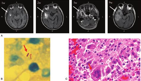 A Contrast Enhanced Brain Magnetic Resonance Imaging Mri Of Patient