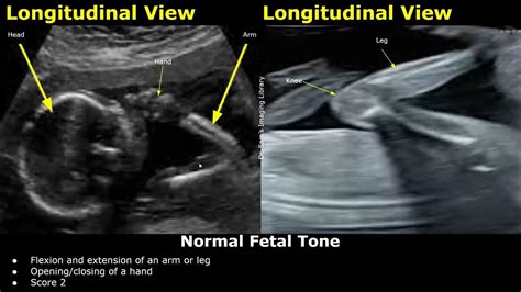 Fetal Biophysical Profile Ultrasound Normal Vs Abnormal Values Fetus