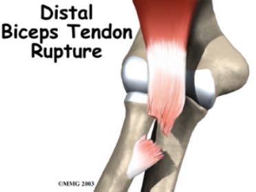 Distal Biceps Tendon Tear — Dr. Tyler Marshall, M.D. shoulder and sports medicine Birmingham, AL