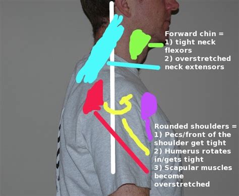 neck strain | Massage therapy, Neck strain, Trigger point therapy