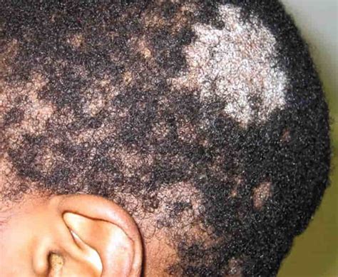 Scalp ringworms: Symptoms, causes and prevention