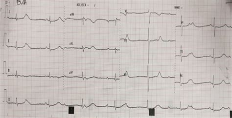 Ecg With Complete Heart Block Download Scientific Diagram