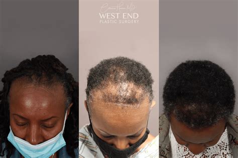 Alopecia Hair Loss Treatment Washington D C