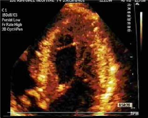 Two Dimensional Echocardiogram Four Chamber Apical View Showing