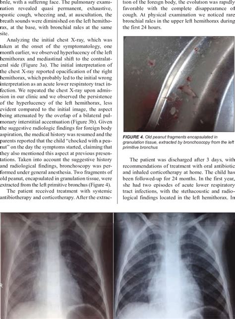 A Chest X Ray Performed At The Time Of Foreign Body Aspiration B