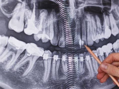 Breaking Down Dental X Rays Part 1 The Smile Hq