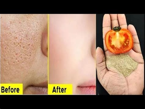 How To Get Rid Of Large Open Pores Permanently Within Day Large