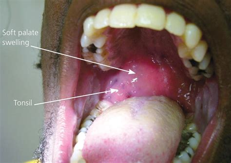 Mancha Branca Na Amigdala - Mancha De Drenagem Branca Na Amigdala Abscesso Dentário é Um Sinal