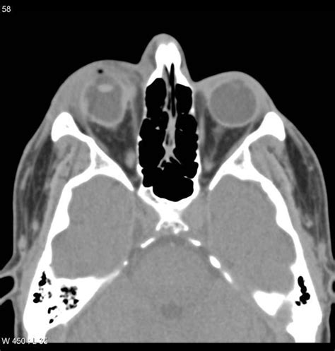 Ruptured Globe Collapsed Globe Presence Of Intraocular Air Or A