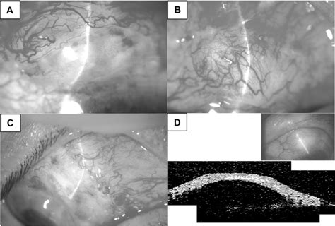 Images Of Three Representative Cases Notes A C Filtering Blebs Post