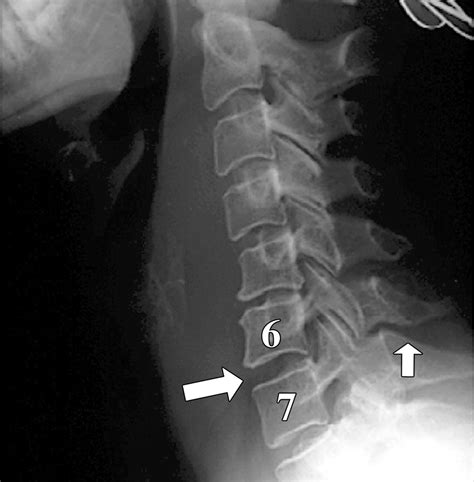 Spectrum Of Imaging Findings In Hyperextension Injuries Of The Neck