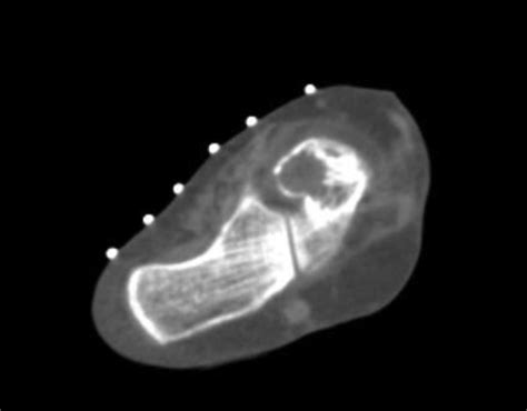 Ct Guided Needle Biopsy Demonstrating The Lytic Bone Lesion Of The Talus Download Scientific