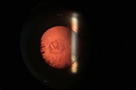 What Is A Posterior Subcapsular Cataract West Boca Eye Center