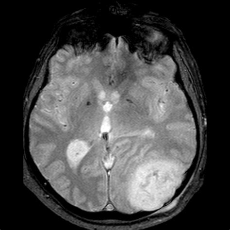 Intracranial Epidermoid Cyst Posterior Fossa Image