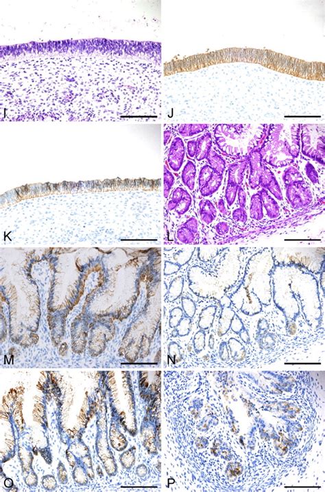 Epstein Barr Virus Associated Gastric Carcinoma A Distinct Carcinoma