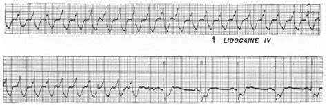 Effect Of Lidocaine On Ventricular Arrhythmias In Patients With